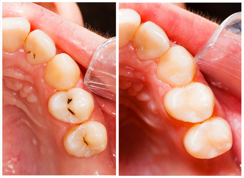 fillings Linden, NJ