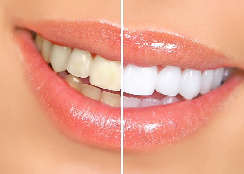 teeth whitening services Linden, NJ